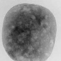 First Case of Monkeypox in the US This Year Confirmed in Massachusetts