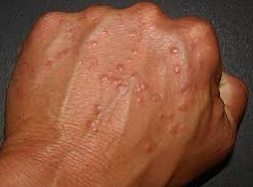 WHO Investigates Possible Sexual Transmission of Monkeypox Amid Ongoing Outbreak